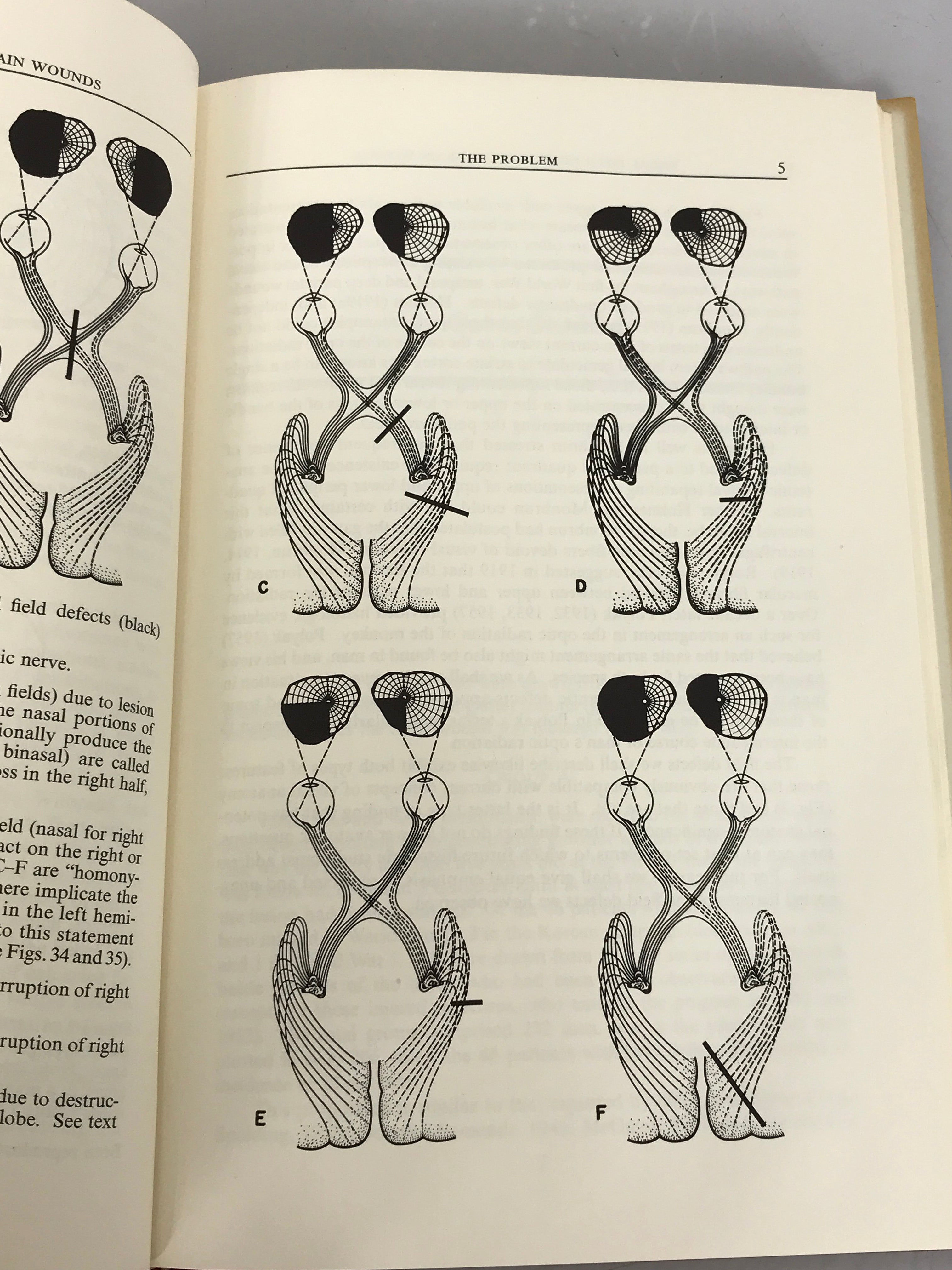 Visual Field Defects After Penetrating Missile Wounds of the Brain by Teuber, Battersby, and Bender 1960 HC DJ