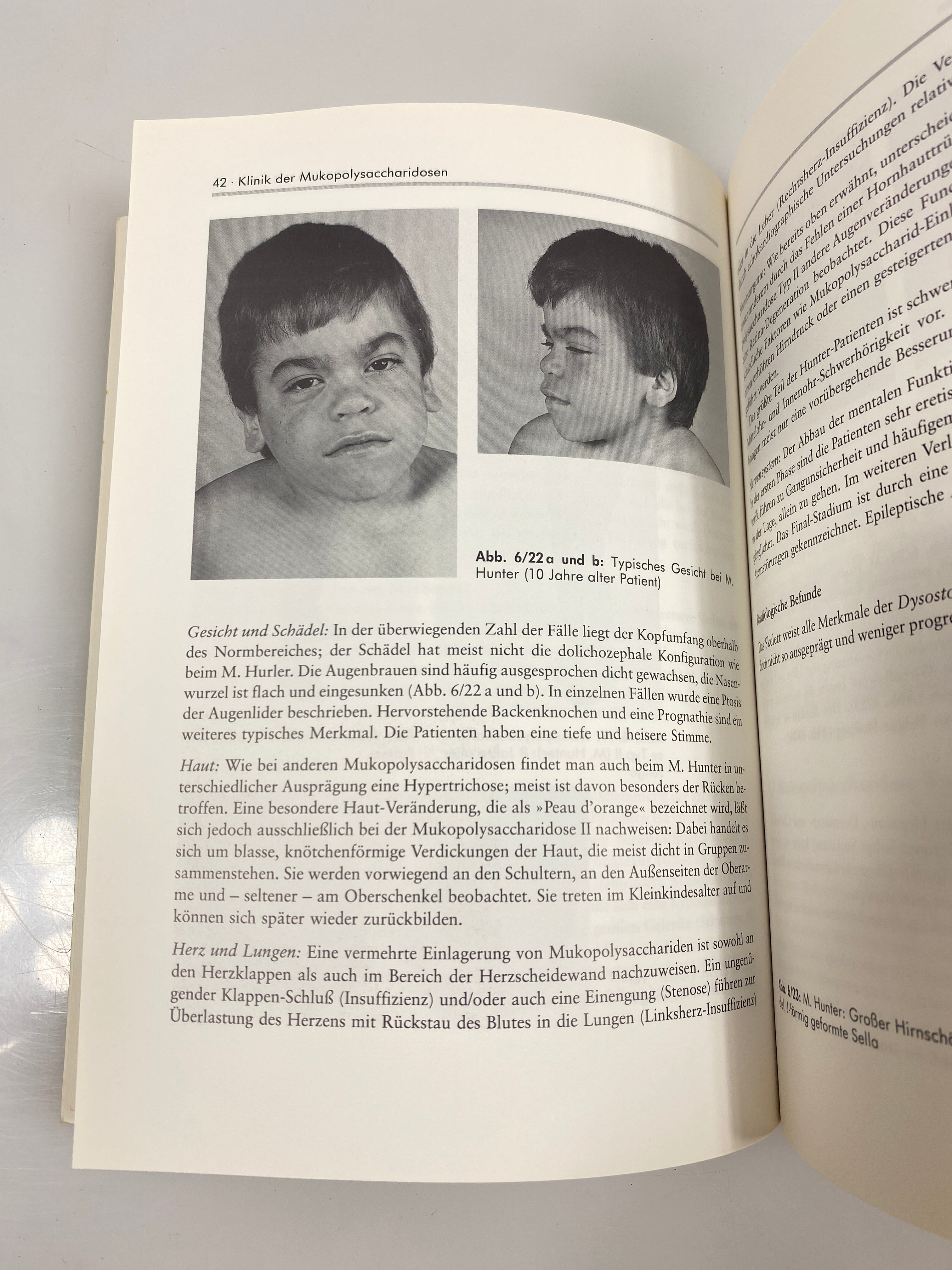 Die Mukopolysaccharidosen by Beck/Fang-Kircher 1993 SC