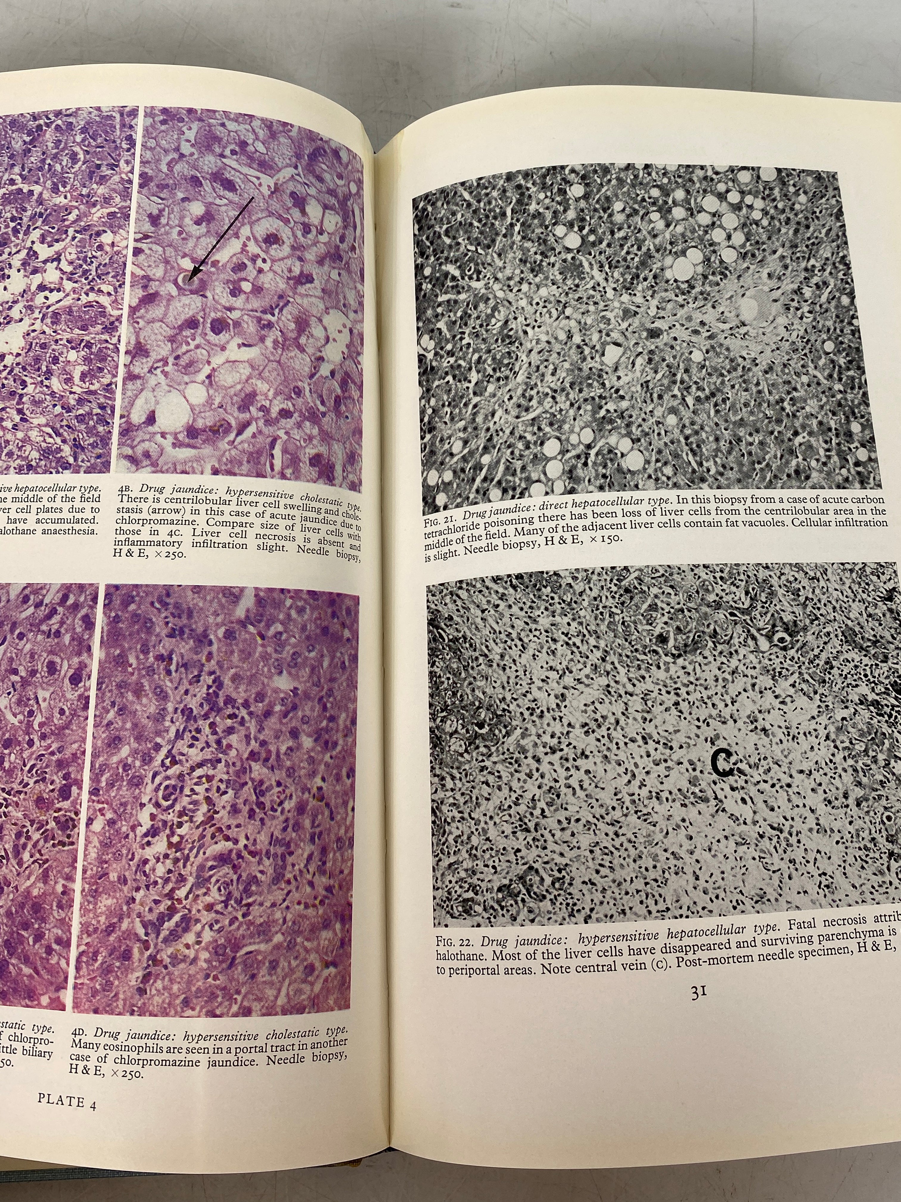Liver Biopsy Interpretation Peter Scheuer 1970 1st Ed Reprint HC