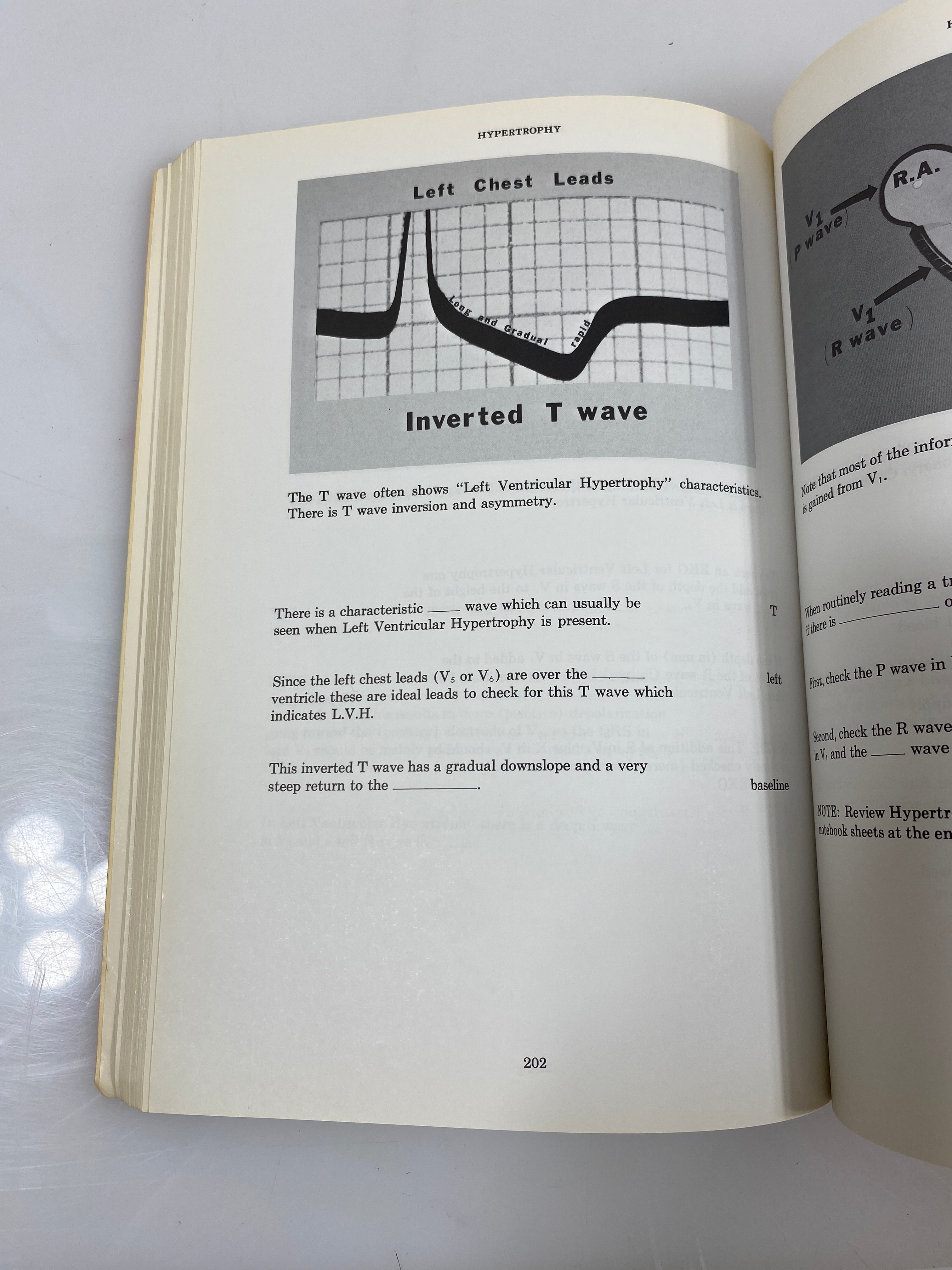 Rapid Interpretation of EKG's by Dubin 1975 SC